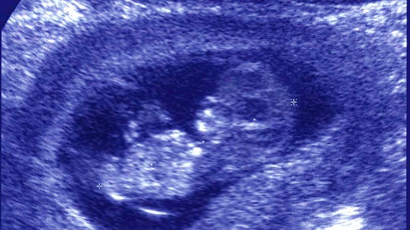 Historic First: U.S. Woman Gives Birth After Uterus Transplant