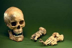 Leprosy Explained: How the Disease Affects the Body