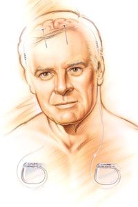 Deep Brain Stimulation Explained: How It Treats Movement Disorders