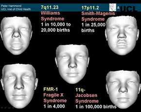 Dysmorphology: Detecting Genetic Disorders Through Facial Analysis