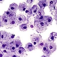 Circumcision and HIV: How Removing the Foreskin Lowers Men’s Risk