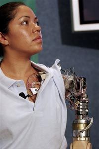 Harnessing the Mind: How Brain‑Controlled Bionic Arms Transform Rehabilitation