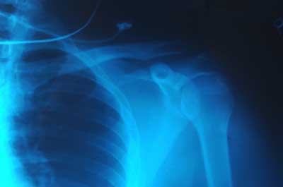 Understanding X-rays: How They Work & Their Medical Impact