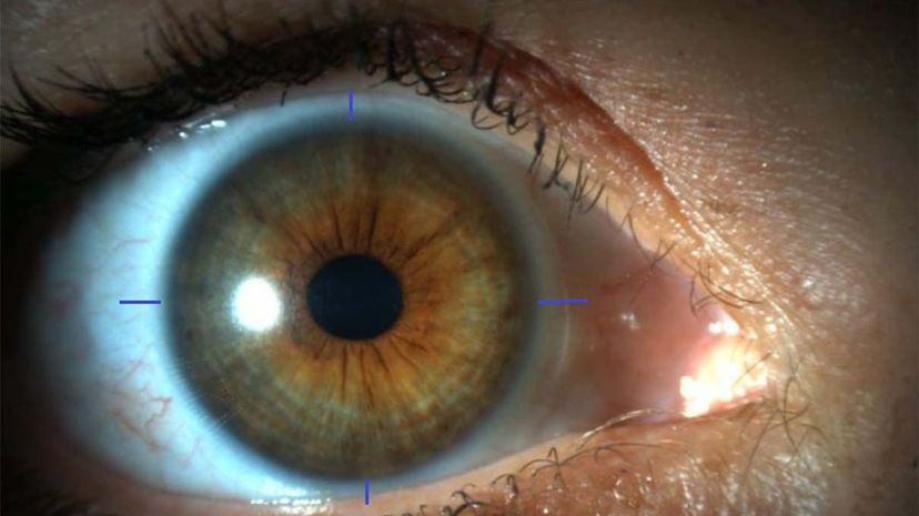 Scientists Achieve 3D Printing of Human Corneas, Offering New Hope for Transplant Patients