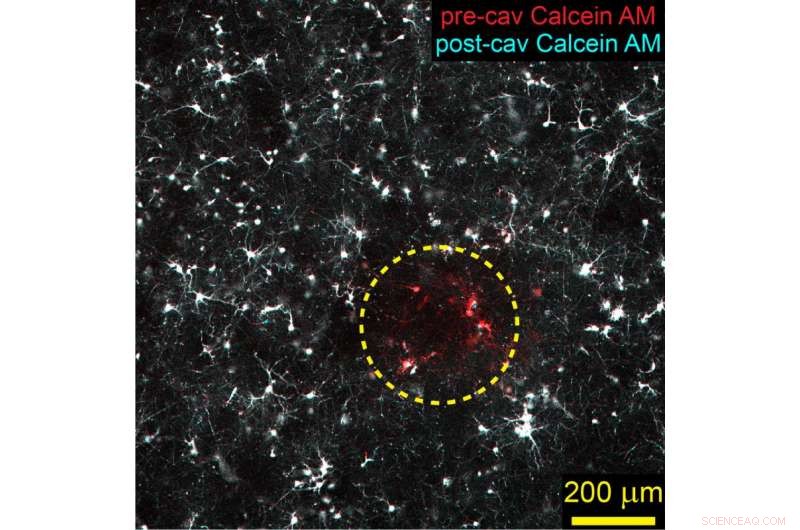 How Cavitation Drives Blast Traumatic Brain Injury: A Scientific Insight