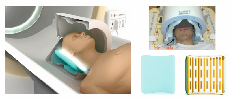 First Human Trial of Metamaterial‑Enhanced MRI Boosts Local Sensitivity