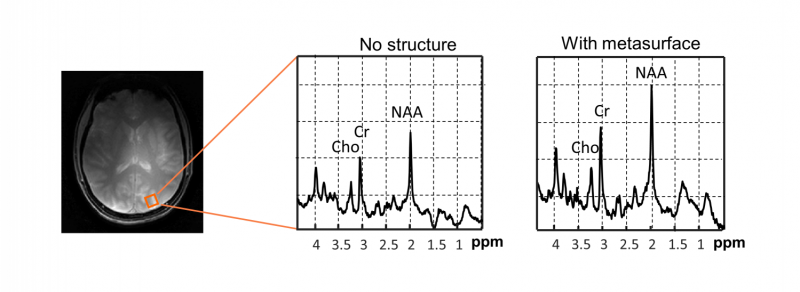 First Human Trial of Metamaterial‑Enhanced MRI Boosts Local Sensitivity