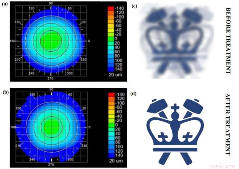 Revolutionary Non‑Invasive Vision Correction Developed by Engineers