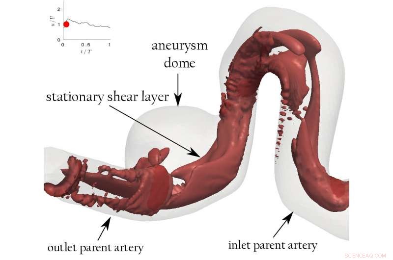 Aneurysm Score Could Guide Surgeons in Treatment Choices