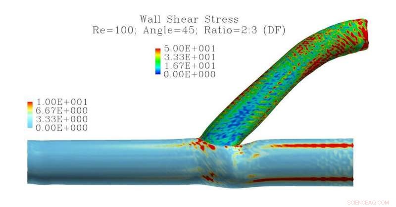 Simulations Uncover Turbulence in Dialysis Arteriovenous Grafts