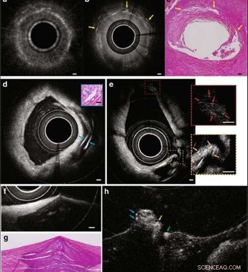 High-Resolution 3D Cardiac Imaging via Few-Mode Interferometry for Accurate Coronary Artery Disease Diagnosis