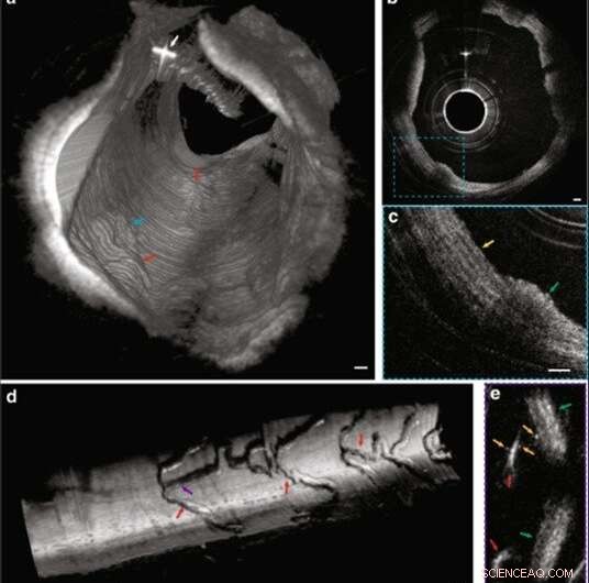 High-Resolution 3D Cardiac Imaging via Few-Mode Interferometry for Accurate Coronary Artery Disease Diagnosis