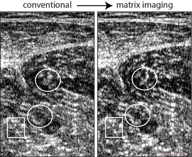 Matrix Imaging: A Breakthrough for Enhanced Ultrasound Resolution