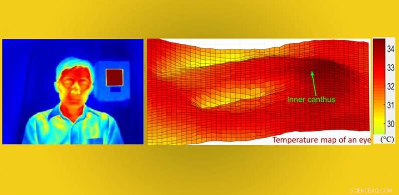 Enhancing Fever Screening: Full-Face Infrared Thermography Improves Accuracy