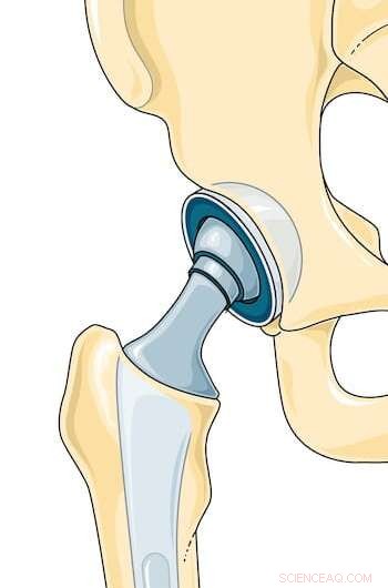 Pioneering Study Uses Fluid Dynamics to Predict and Improve Hip Implant Longevity