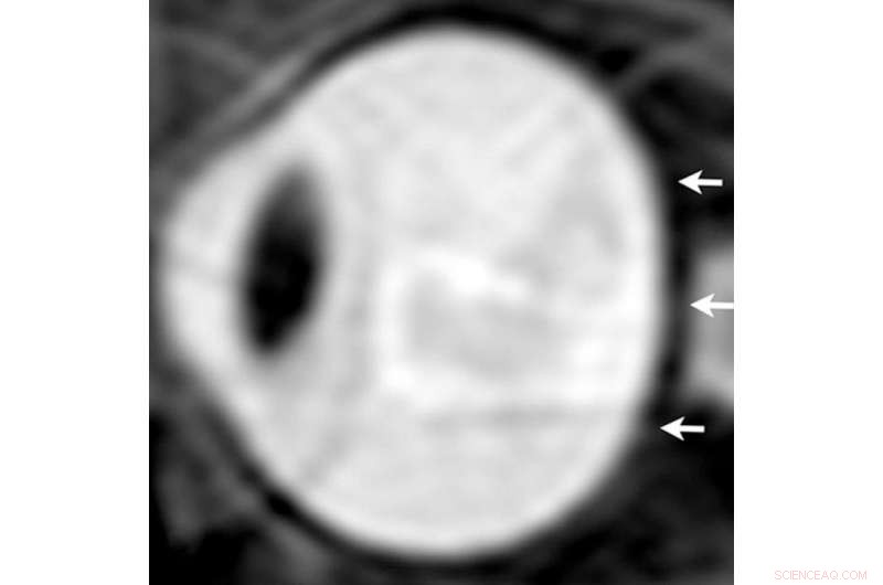 Groundbreaking Study Reveals Cause of Visual Impairment in Long-Duration Space Missions