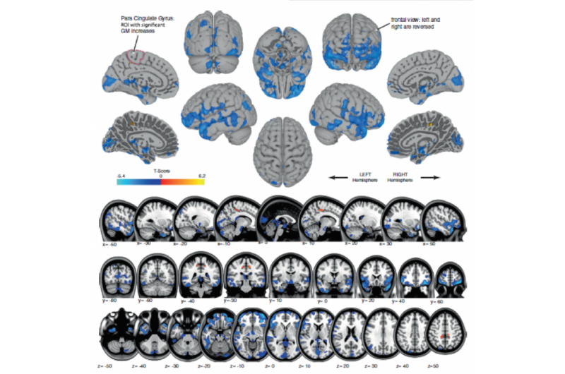 How Spaceflight Alters Astronauts  Brains: Structural Changes and Neural Plasticity