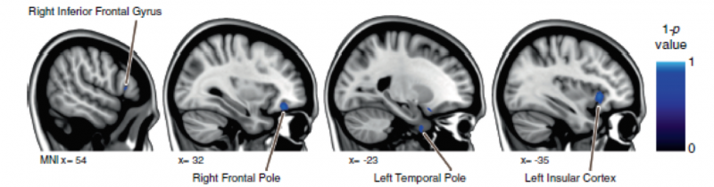 How Spaceflight Alters Astronauts  Brains: Structural Changes and Neural Plasticity