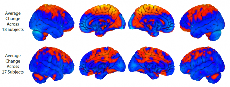 How Spaceflight Alters Astronauts  Brains: Structural Changes and Neural Plasticity
