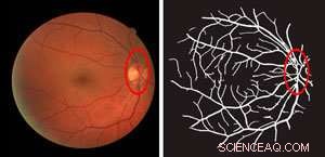 New Image Processing Algorithm Enhances Retinal Blood Vessel Mapping