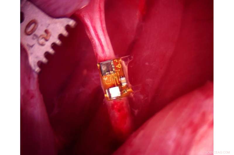 New Ultrasonic Nerve Stimulator Sets Record for Smallest Volume and Highest Efficiency