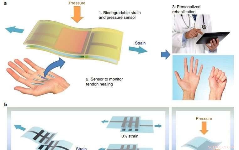 Biodegradable Implantable Sensor Degrades After Healing Monitoring Is Complete