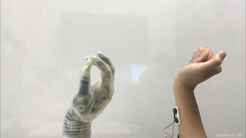 Innovative Technology Enhances Control of Prosthetic Hands for Patients