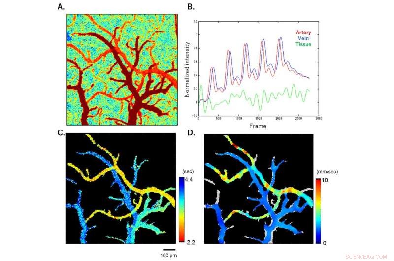 Advanced Blood Flow Imaging Enhances Neurosurgical Precision in the Human Brain