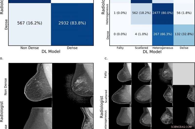AI System Detects Dense Breast Tissue, Key Breast Cancer Risk Indicator, in Mammograms