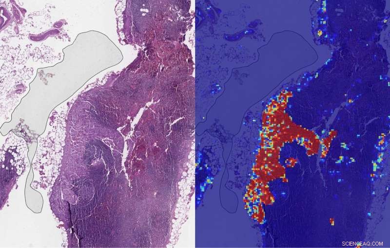 Google Advances AI Tool for Detecting Breast Cancer Spread