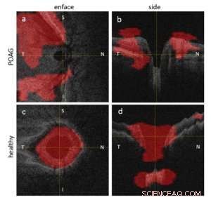 Harnessing Deep Learning for Precise Glaucoma Diagnosis