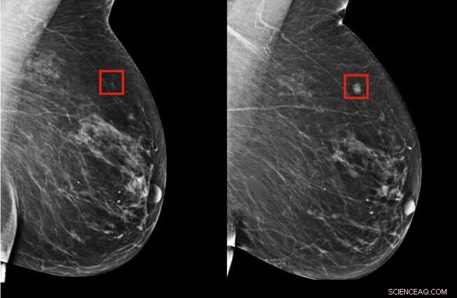 AI-Driven Prediction of Breast Cancer Risk and Personalized Care