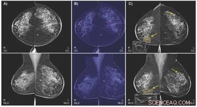 AI Model Combines Imaging and Health Data to Predict Breast Cancer Early
