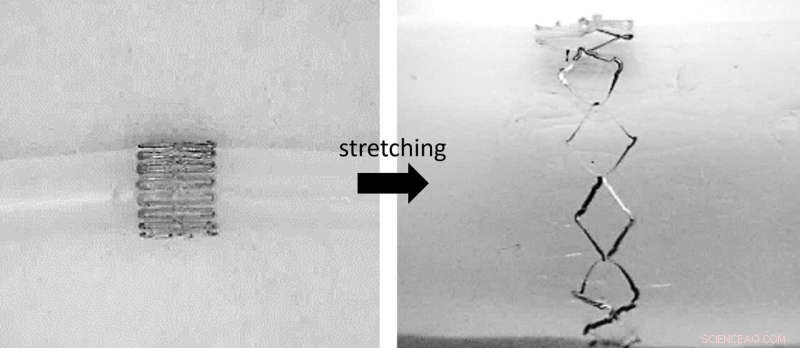 Innovative Stretchable Wireless Sensor Enables Continuous Monitoring of Cerebral Aneurysm Healing