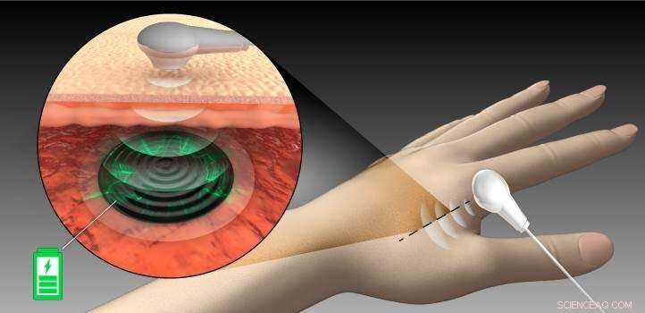 Revolutionary Implantable Device Enables Skin‑Based Battery Charging for Pacemakers