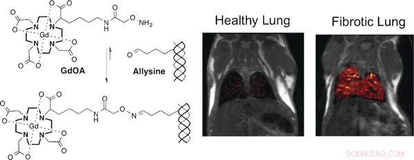 New Gadolinium Probe Enables Noninvasive MRI of Lung Fibrosis Development