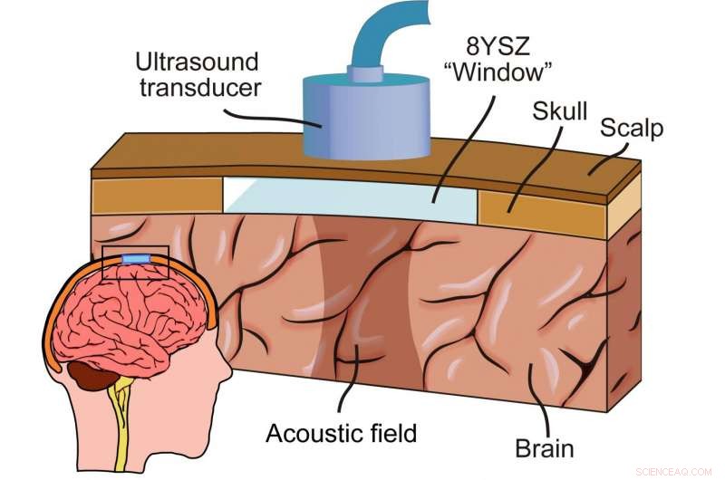 Delivering Therapeutic Ultrasound Through Thick Skulls with Advanced Ceramic Implants