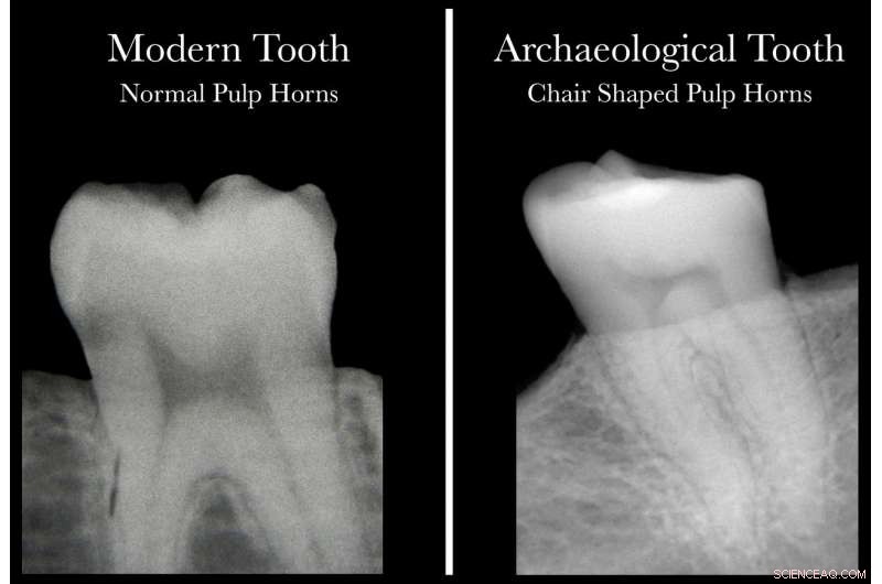 Dental X‑Rays Uncover Vitamin D Deficiency: A Breakthrough in Health Screening