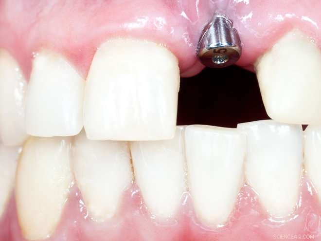 Advanced Strategies for Managing Infected Dental Implants
