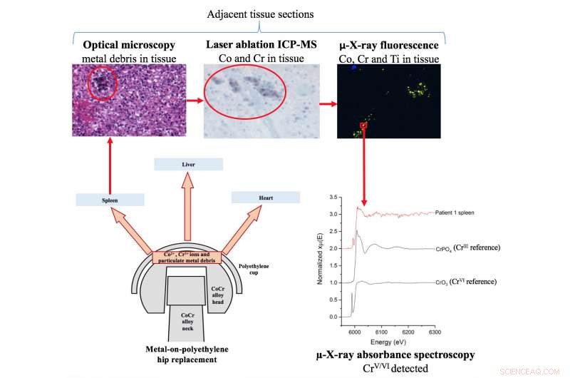 Evaluating Metal Accumulation in Organs After Joint Replacement Surgery