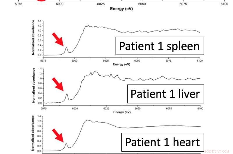 Evaluating Metal Accumulation in Organs After Joint Replacement Surgery