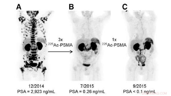 Scientists Develop Breakthrough Method to Produce Rare Actinium‑225 for Cancer Therapy