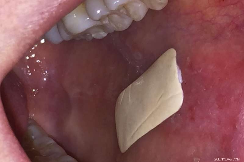 Adhesive Mouth Plaster Accelerates Healing of Oral Ulcers