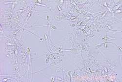 Revolutionary Clip‑On Smartphone Device Enables Rapid Sperm Analysis for Male Fertility Testing