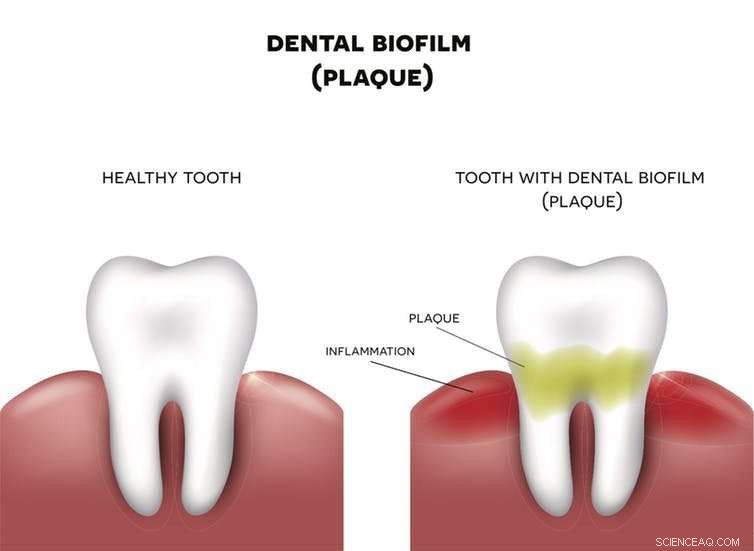 Scientists Battle Biofilm Infections: New Strategies Against Resistant Bacteria