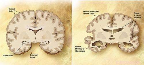 New Drug Shows Promise in Preventing Brain Cell Death for Alzheimer’s Patients