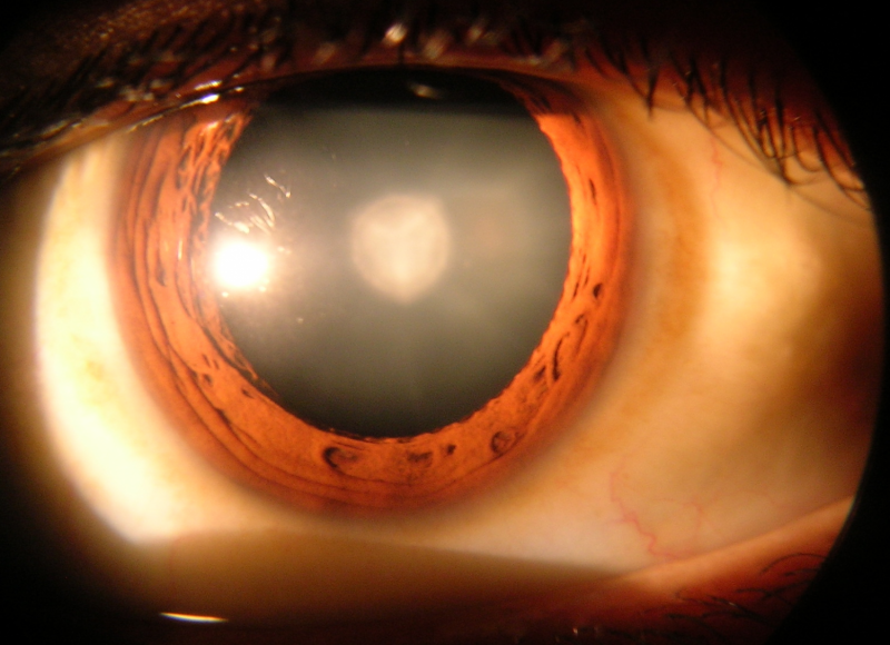 New Lab Findings Uncover Chemical Reaction Driving Cataract Development