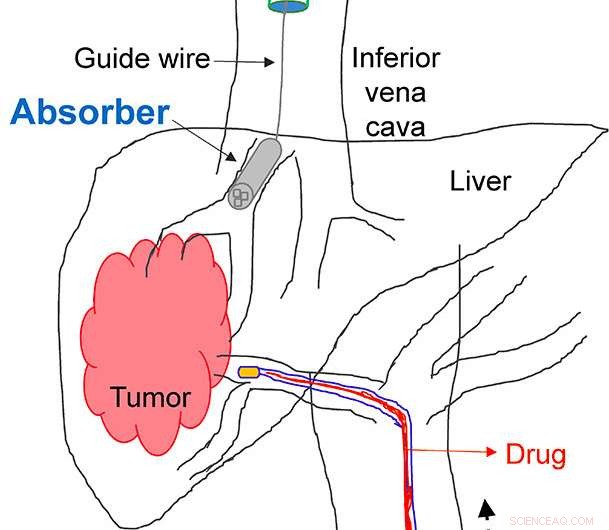 3D-Printed Drug Sponge Promises Lower Side Effects in Cancer Treatment