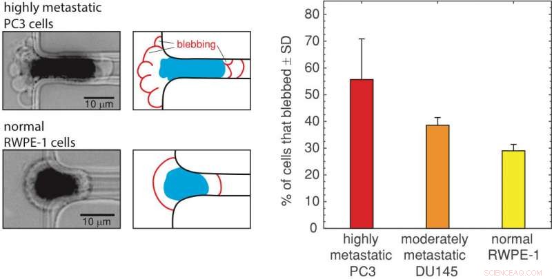 Revolutionary Technique Enhances Detection of Metastatic Prostate Cancer