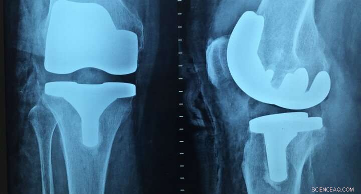 Advanced Thermoplastic Biomaterial Promises Stronger, More Versatile Medical Implants